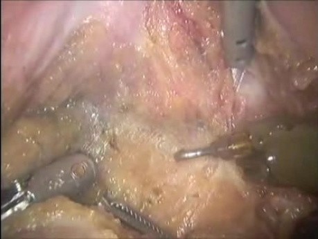 Concomitant Prostata Cancer - Robotic TME Excision