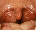 Massively Enlarged Tonsils