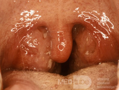 Massively Enlarged Tonsils