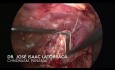 Laparoscopic Resection of Giant Peritoneal Cyst
