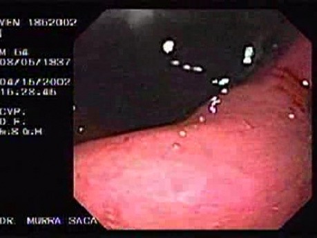 Zollinger- Ellison Syndrome - Gastric Ulcer with Gastrocolic Fistula (1 of 21)