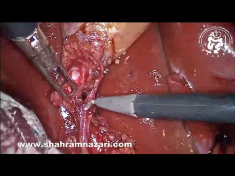 Skletonizing Cystic Duct and Artery to Make Critical View of Safety