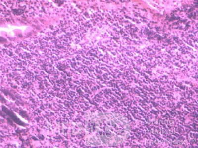 Lymphoma B small cells of the Jejuno (7 of 10)