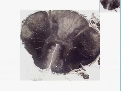 Subacute combined degeneration of pernicious anemia