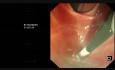Upside Down ERCP After Polya Gastrectomy