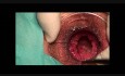 Stapled Haemorrhoidopexy