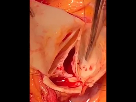 Introducing Two Cases of Ascending Aorta Dissection and Intimal Flap Rising 