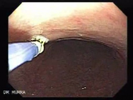 Multiple Gastric Angiodysplasia (6 of 17)