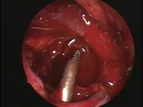 Caldwell Luc Procedure - Endoscopy