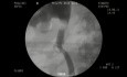 Ureteral access after a surgicaly induced injury