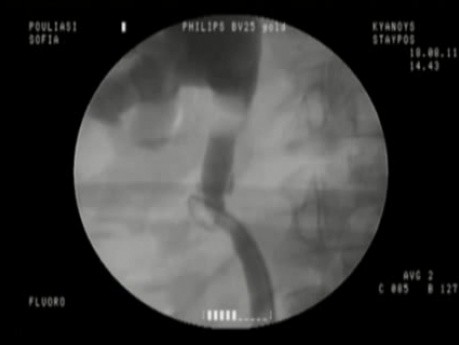 Ureteral access after a surgicaly induced injury