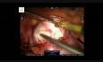 Robotic Myomectomy