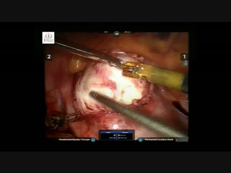 Robotic Myomectomy