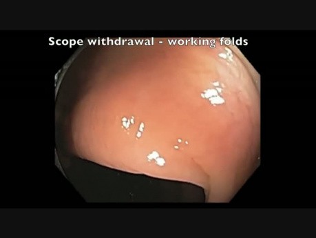 Working The Folds During Screening