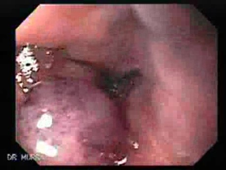 Long Standing Alcohol Abuse - Follow Up After Ligation