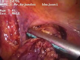 Laparoscopic colon resection
