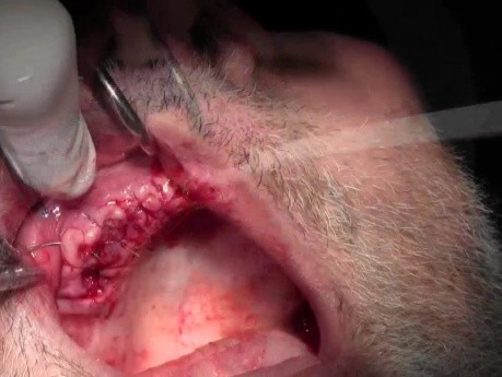 Suturing Technique - Implant Surgery, #5-6-7 Sites