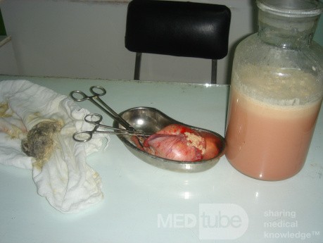 Dermoid Sebacious Material And Hair