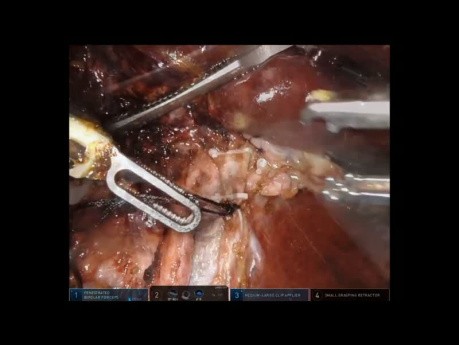 Robotic Left Hepatectomy