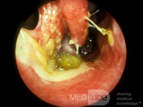 Chronic Bacterial Rhinitis