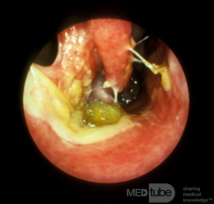 Chronic Bacterial Rhinitis