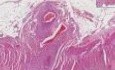 Small Intestine - Rheumatoid Vasculitis