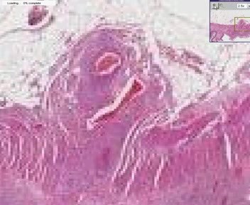 Small Intestine - Rheumatoid Vasculitis
