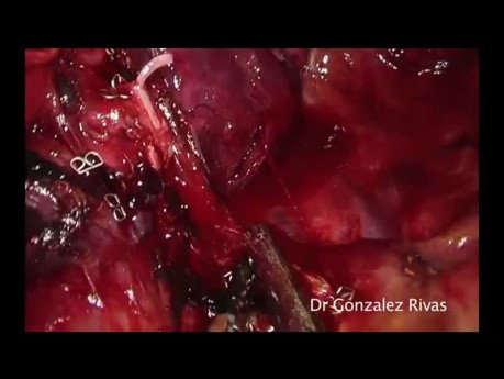 Subxiphoid Uniportal VATS Right Upper Lobectomy