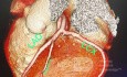 Multislice CT Coronary Angiography