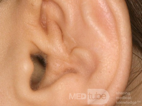 Cauliflower Ear