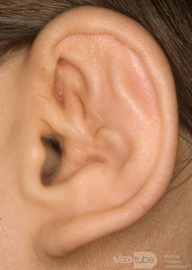 Cauliflower Ear
