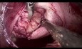 vNOTES Myomectomy | Transvaginal Natural Orifice Transluminal Endoscopic Surgery to Remove Fibroid 
