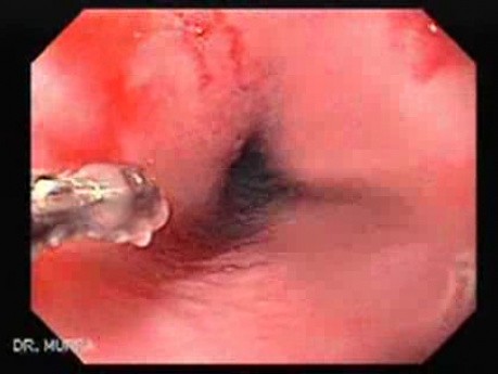 Cytomegalovirus Esophagitis - Biopsy
