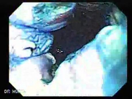 Barrett's Esophagus of long segment (13 of 24)