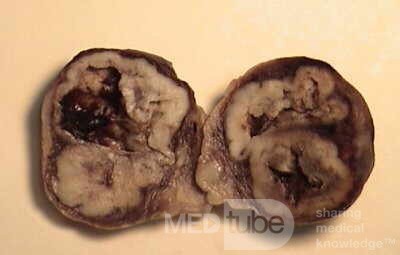 Plastic Linitis with bilateral Krukenberg´s tumor (5 of 13)