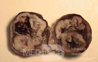 Plastic Linitis with bilateral Krukenberg´s tumor (5 of 13)