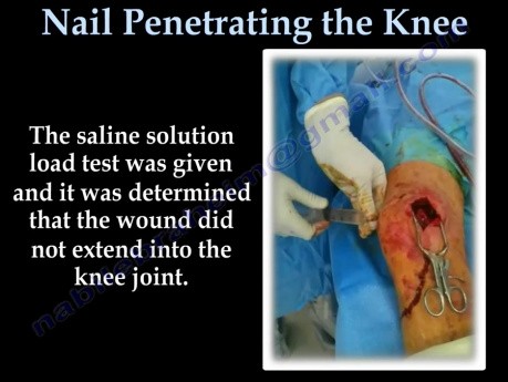 Nail Penetrating the Knee - Video Lecture