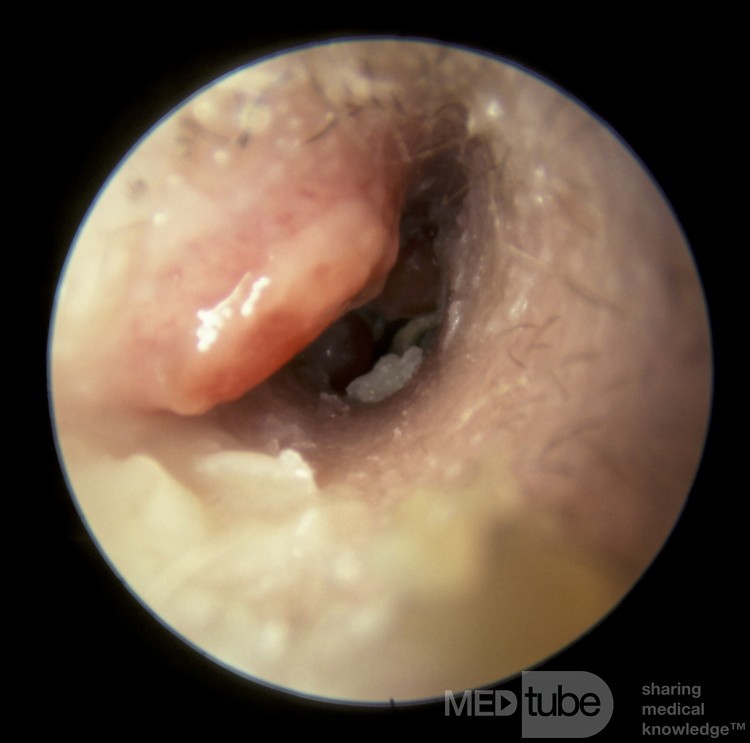 Mastoiditis Draining into the External Canal [right ear]