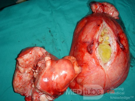 Huge Broad Ligament Degenerated Myoma
