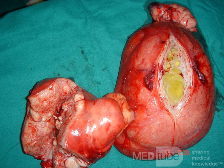 Huge Broad Ligament Degenerated Myoma
