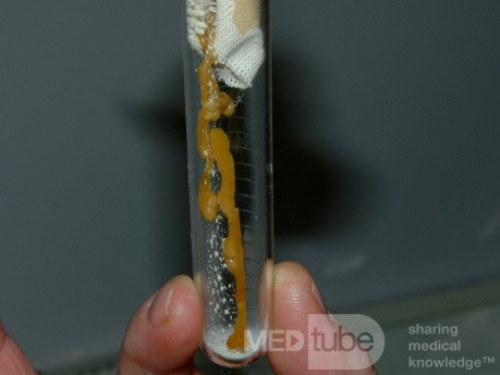 Melted Wax From Ear Candling