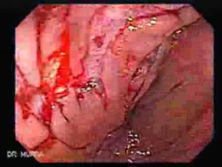 Consecutive colonoscopy with dilation was carried out (11 of 15)