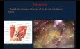 Laparoscopic TEP Repair of a Large Inguinal Hernia: Highlighting the Anatomical Landmarks