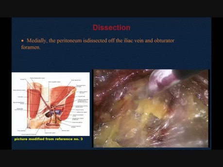 Laparoscopic TEP Repair of a Large Inguinal Hernia: Highlighting the Anatomical Landmarks