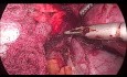 Laparoscopic Right Adrenalectomy for Adrenocortical Cancer - Full Length Procedure