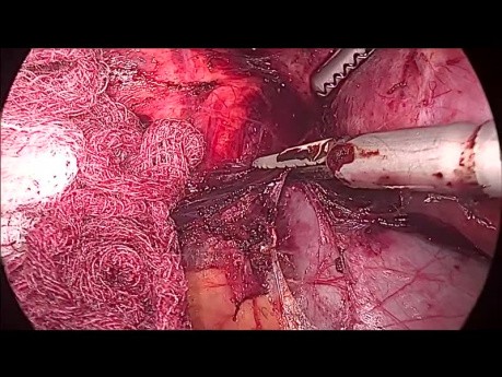 Laparoscopic Right Adrenalectomy for Adrenocortical Cancer - Full Length Procedure