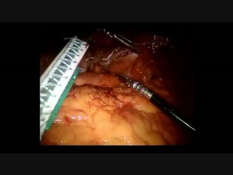 Longitudinal Sleeve Gastrectomy with Posterior Crural Repair