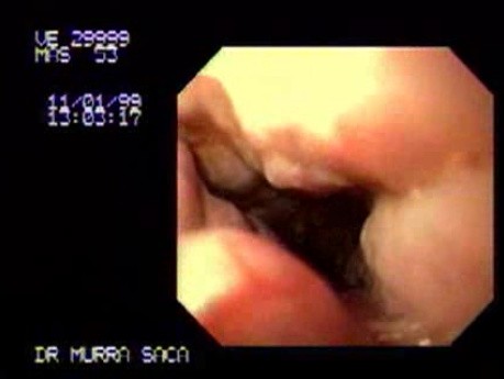 String of Pearls - Presence of Varices of the Esophagus