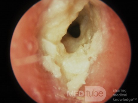 Chronic Otitis Externa Keratin Squames