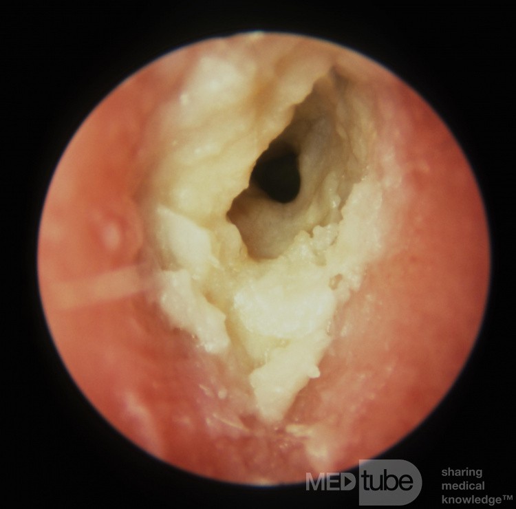 Chronic Otitis Externa Keratin Squames